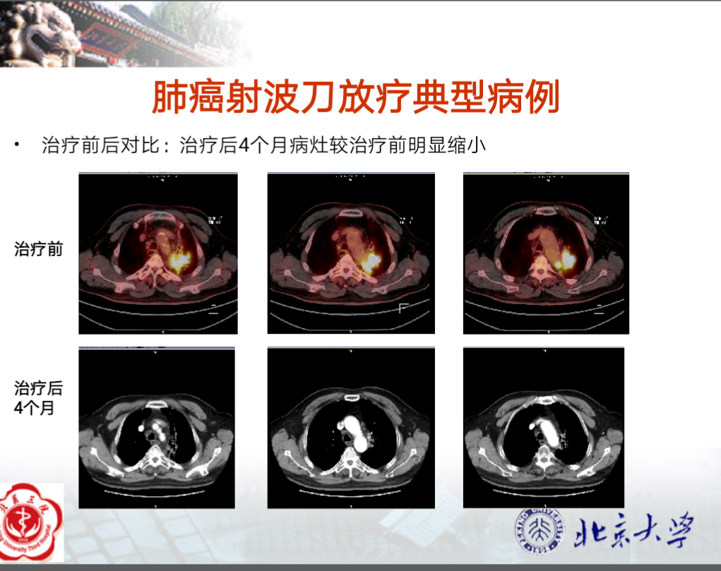 透明细胞癌_戒烟后真的会得癌吗_戒烟激活癌细胞