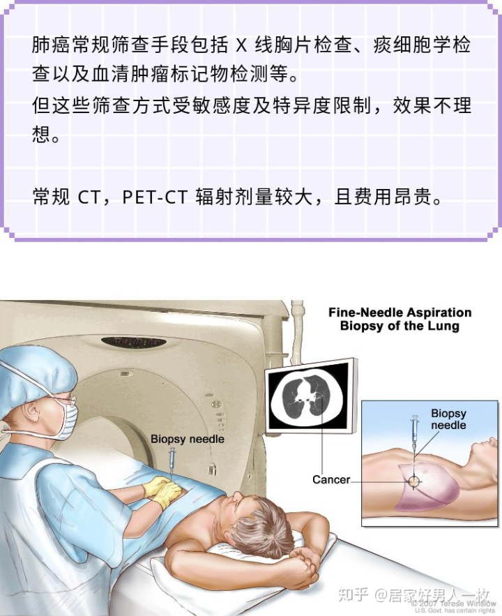 印戒细胞癌 英文_小细胞癌戒烟_戒烟激活癌细胞