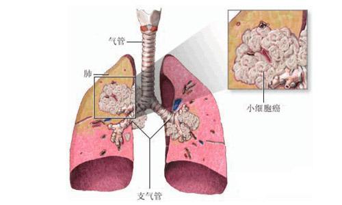 戒烟激活癌细胞_突然戒烟会得癌_印戒细胞癌