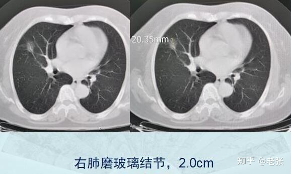 黑色素细胞活跃是癌吗_突然戒烟会得癌_戒烟激活癌细胞