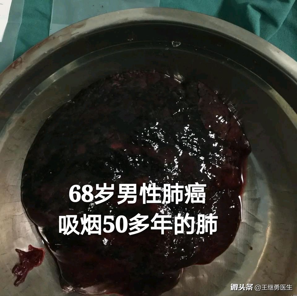 黑色素癌与基底细胞癌那个严重_为什么突然戒烟会得癌_戒烟激活癌细胞