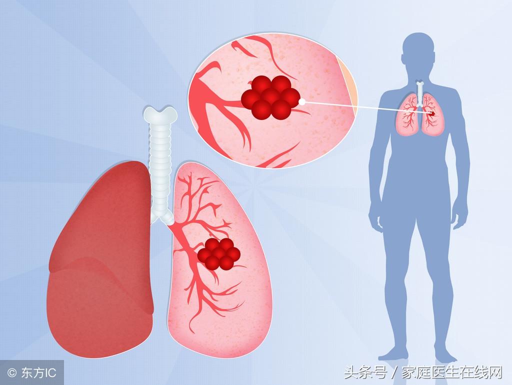 印戒细胞癌_戒烟后得癌的人多不多_戒烟激活癌细胞