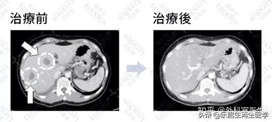 胃癌印戒细胞癌术后饮食_黑色素癌与基底细胞癌那个严重_戒烟激活癌细胞