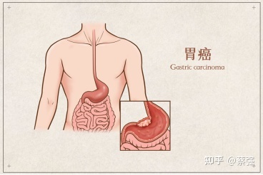 印戒细胞癌早期症状_黑色素细胞癌症状_戒烟激活癌细胞