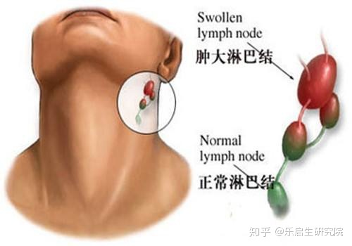 戒烟后真的会得癌吗_戒烟激活癌细胞_黑色素细胞活跃是癌吗