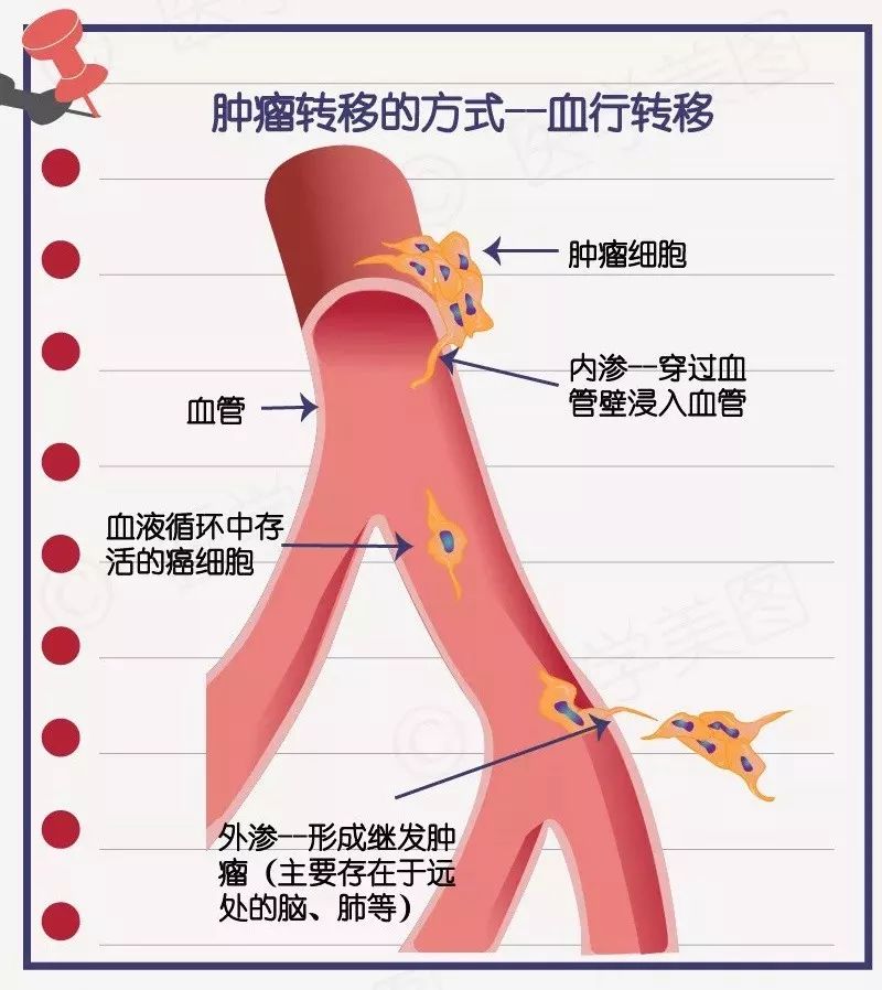 印戒细胞癌_戒烟激活癌细胞_胆管细胞癌早期核磁表现