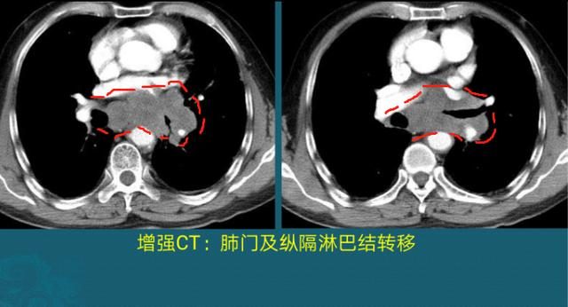 为什么突然戒烟会得癌_黑色素细胞癌_戒烟激活癌细胞